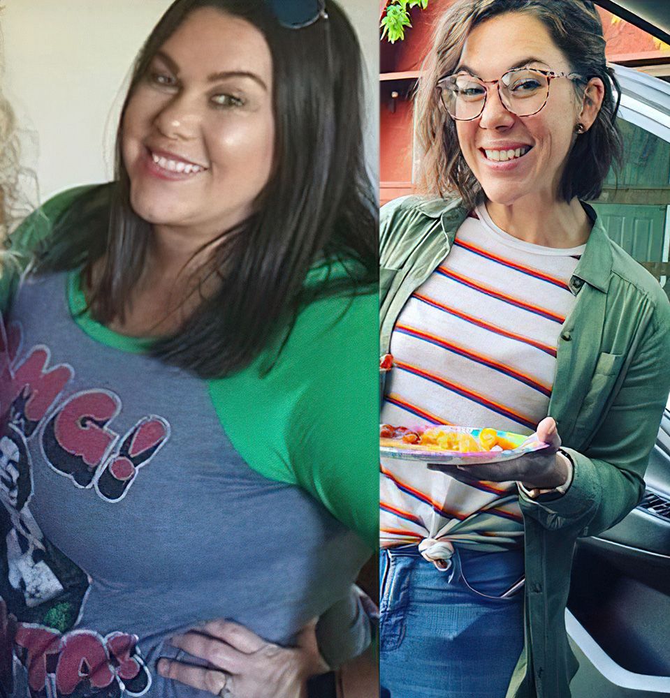 Patient before and after bariatric surgery